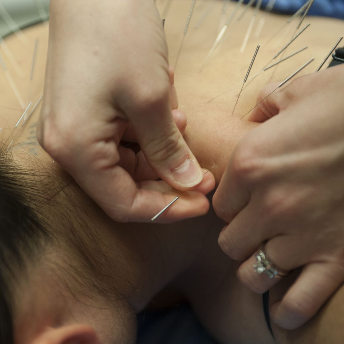 Акупунктура